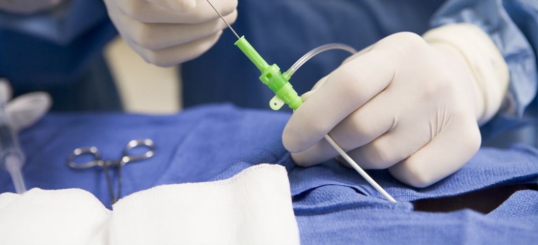 La dénervation rénale, une solution contre l’hypertension