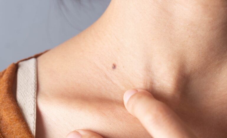 La Société française de dermatologie lance une nouvelle campagne d'autodépistage des cancers de la peau afin d'améliorer sa détection.