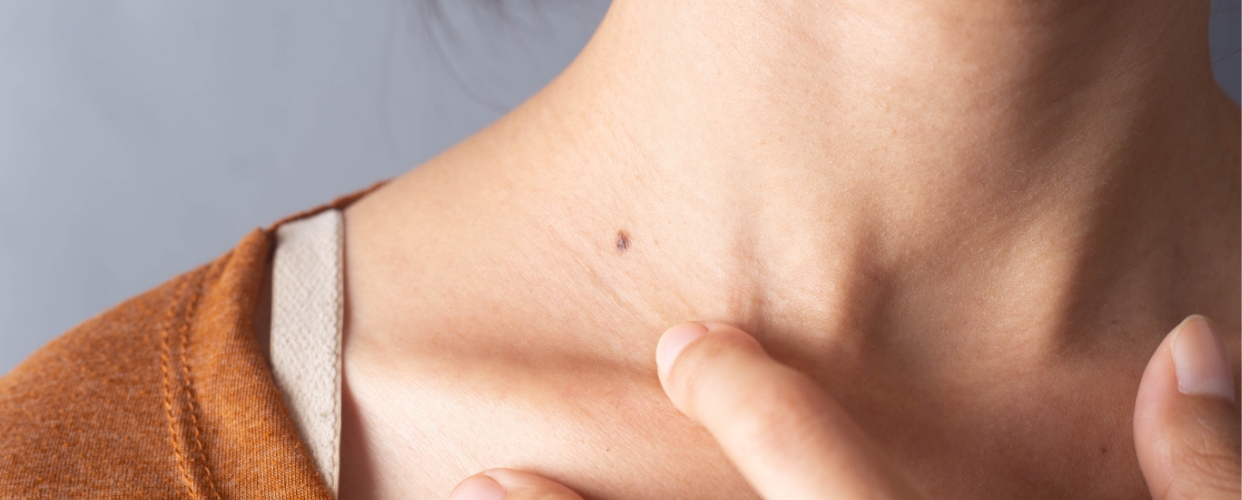 La Société française de dermatologie lance une nouvelle campagne d'autodépistage des cancers de la peau afin d'améliorer sa détection.