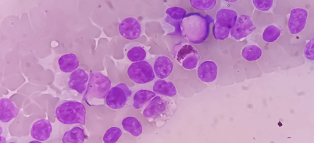 Des chercheurs ont mis au point une stratégie innovante d’immunothérapie capable de déclencher une réponse immunitaire et détruire les cellules cancéreuses. Après des résultats concluants chez la souris, des recherches supplémentaires seront nécessaires afin d’en évaluer l’efficacité chez l’être humain.