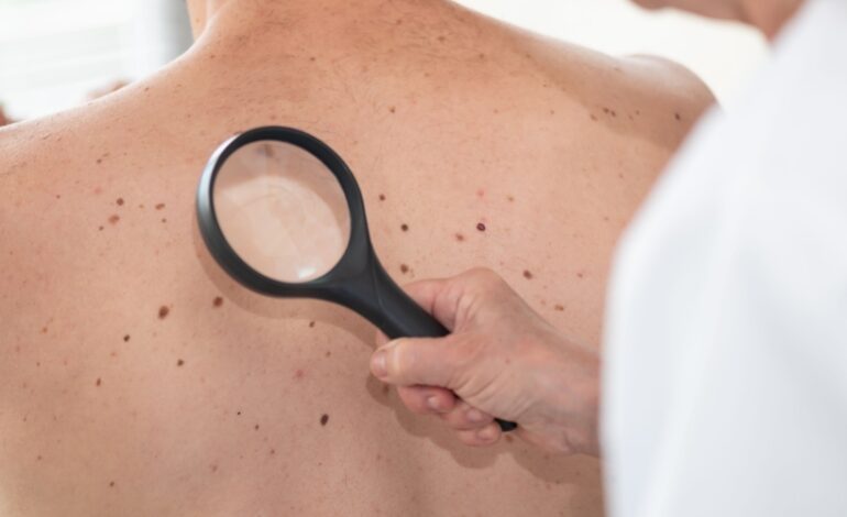 À l’approche de l’été, le Syndicat national des dermatologues-vénérologues alerte sur les risques liés à l’exposition au soleil et invite les Français à être plus vigilants.