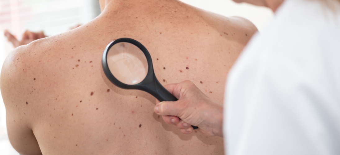 Face au soleil, les réflexes de protection restent encore insuffisants